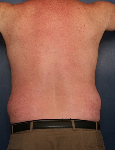 Before Image: Liposuction - back