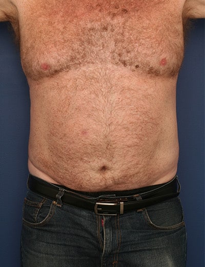 After Image: Liposuction - front