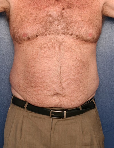 Before Image: Liposuction - front