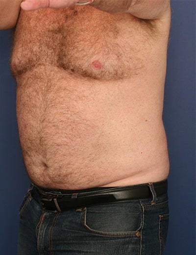 After Image: Liposuction - left-front-oblique