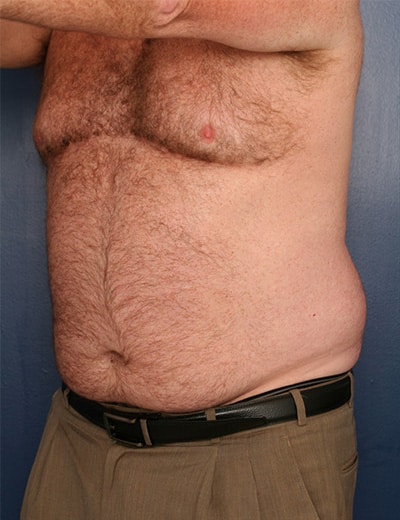 Before Image: Liposuction - left-front-oblique