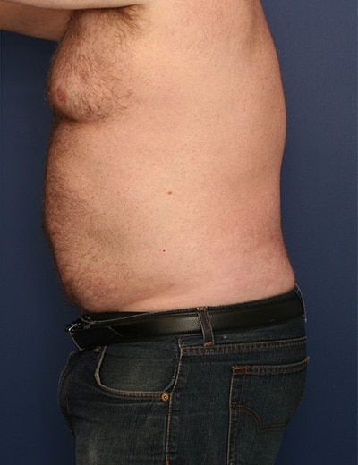 After Image: Liposuction - left-side