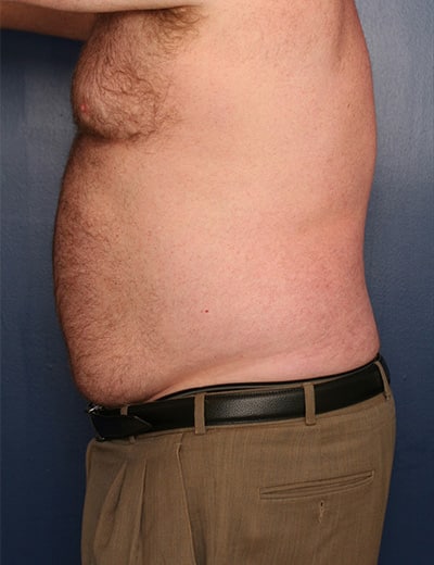 Before Image: Liposuction - left-side