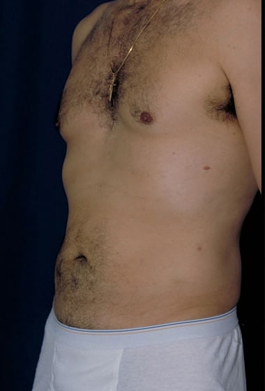 After Image: Liposuction - left-front-oblique