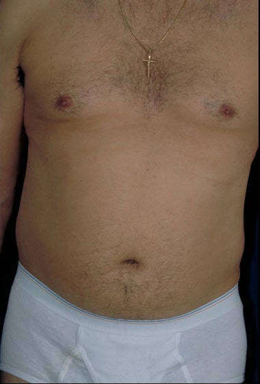 Before Image: Liposuction - front