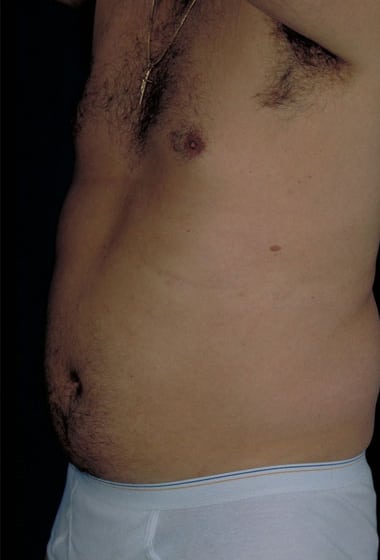 Before Image: Liposuction - left-front-oblique