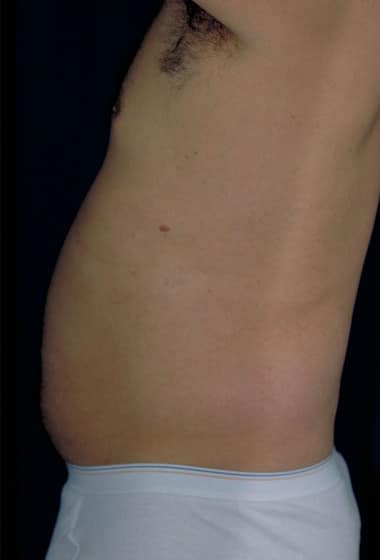 Before Image: Liposuction - left-side