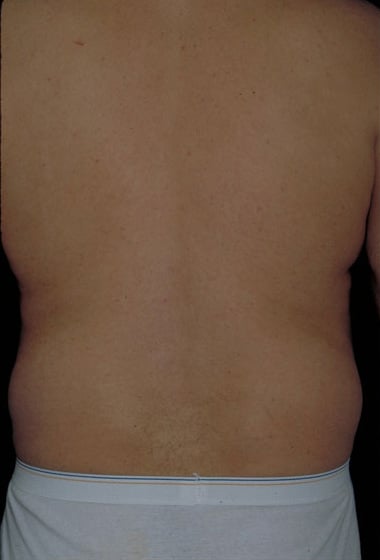 Before Image: Liposuction - back