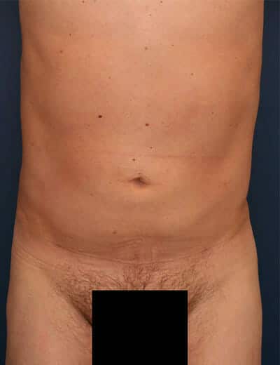 After Image: Liposuction - front