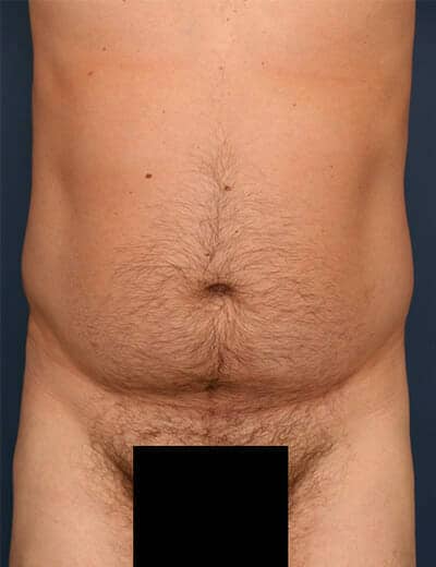 Before Image: Liposuction - front