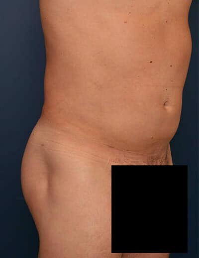 After Image: Liposuction - right-front-oblique