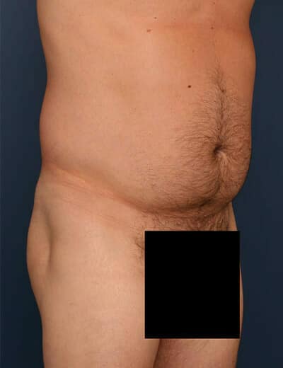 Before Image: Liposuction - right-front-oblique