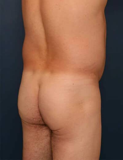 Before Image: Liposuction -