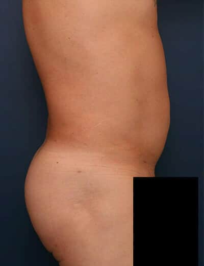 After Image: Liposuction - right-side