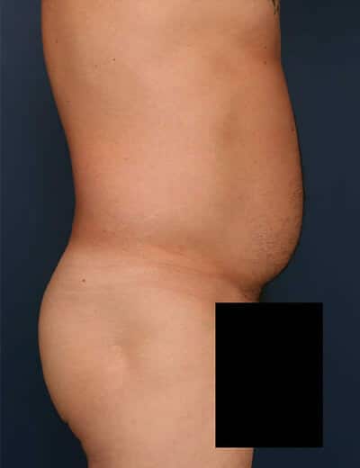 Before Image: Liposuction - right-side