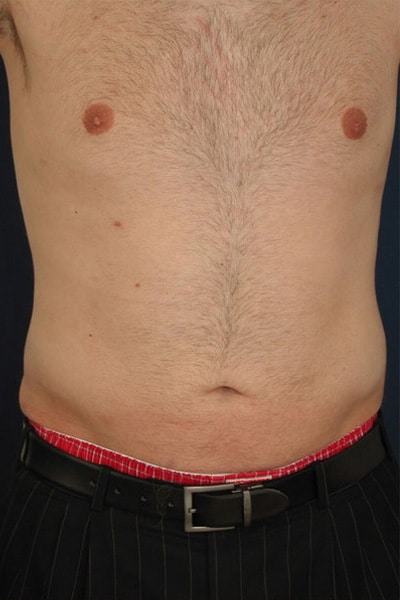 After Image: Liposuction - front