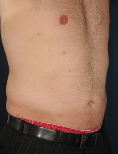 After Image: Liposuction - right-front-oblique