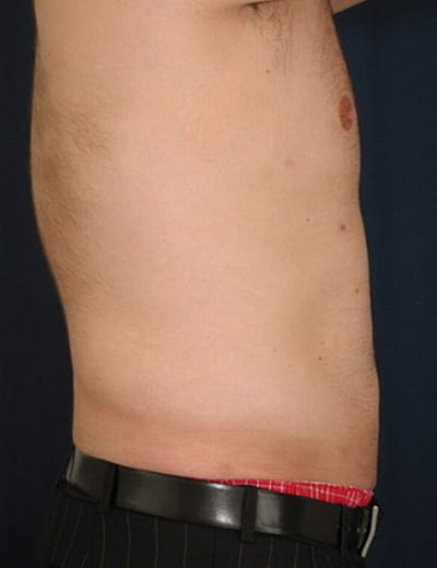 After Image: Liposuction - right-side