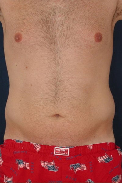 Before Image: Liposuction - front