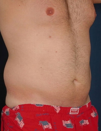 Before Image: Liposuction - right-front-oblique