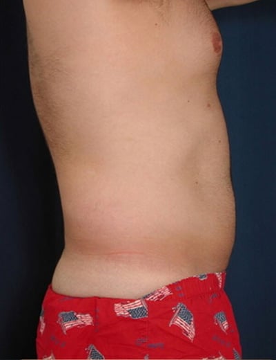 Before Image: Liposuction - right-side