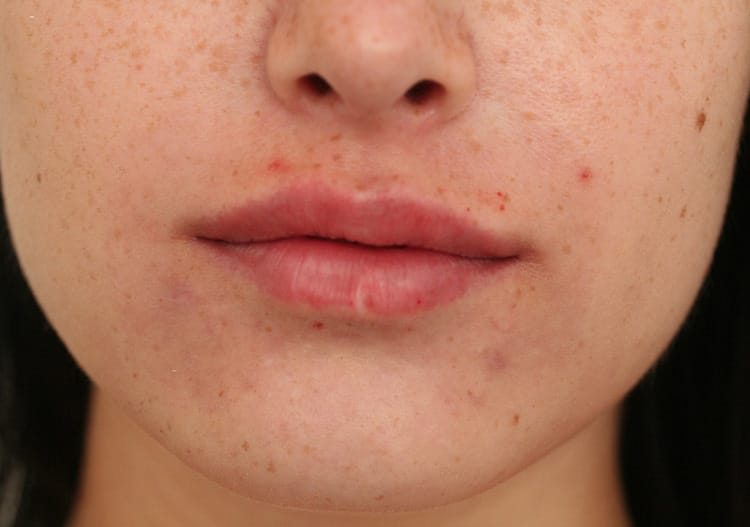 After Image: Lips Juvederm Ultra - front