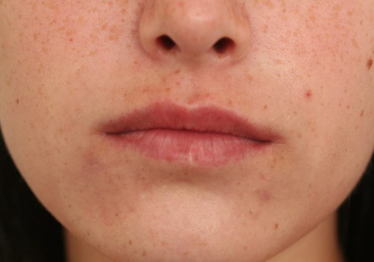Before Image: Lips Juvederm Ultra - front