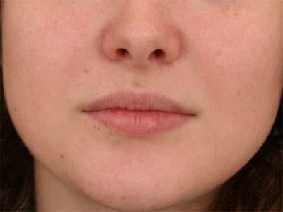 Before Image: Lips Juvederm Ultra - front
