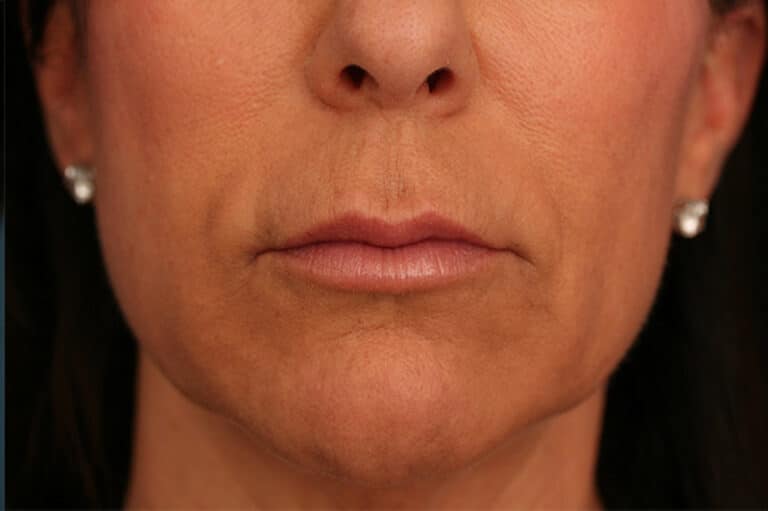 After Image: Lips Refyne - front