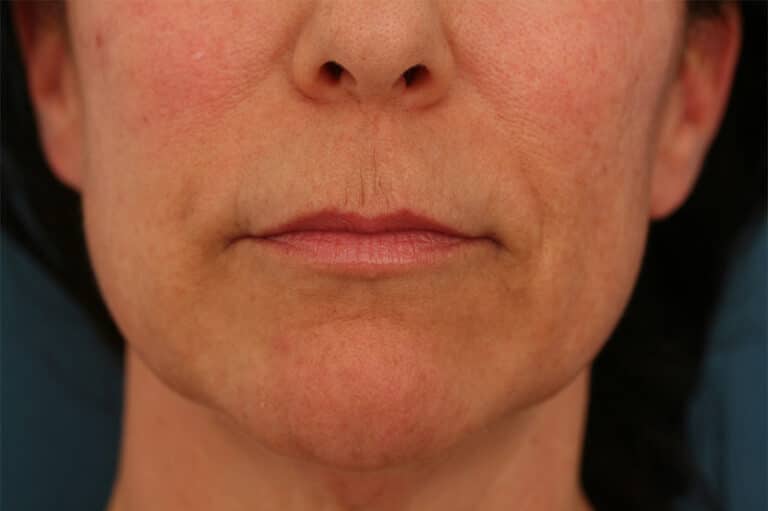 Before Image: Lips Refyne - front