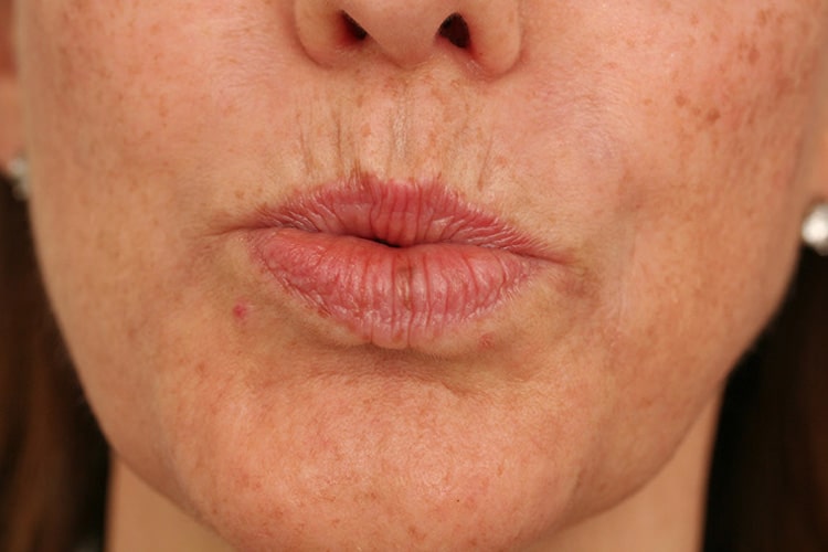 Before Image: Lips Volbella - front