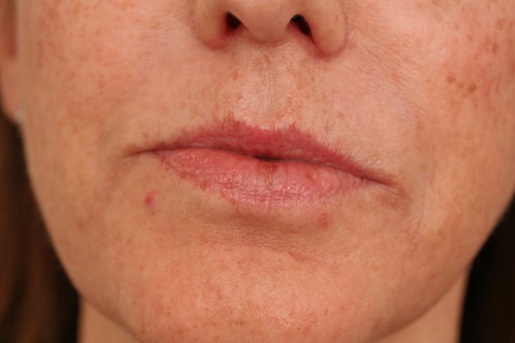 Before Image: Lips Volbella - front