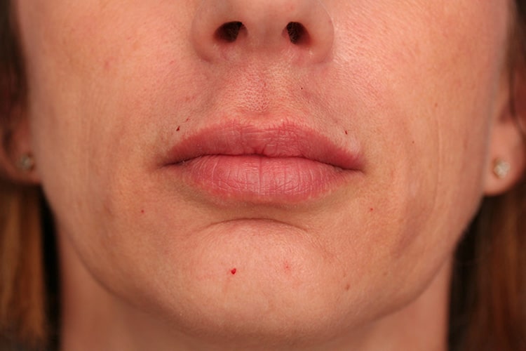 After Image: Lips Juvederm Ultra - front