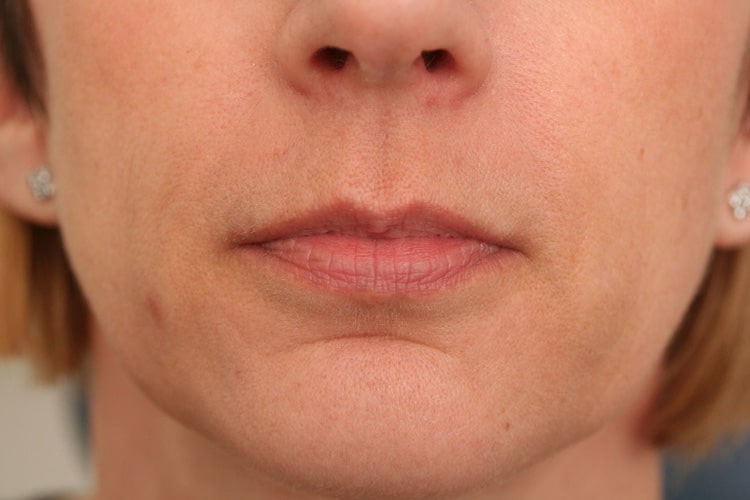 Before Image: Lips Juvederm Ultra - front