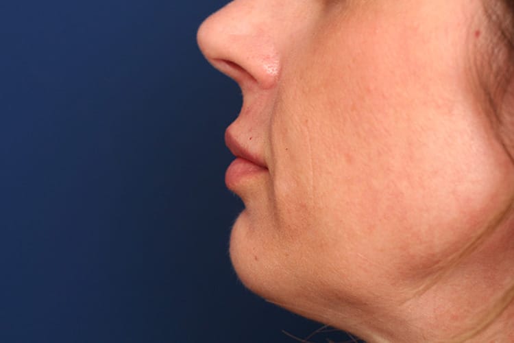 After Image: Lips Juvederm Ultra - left-side