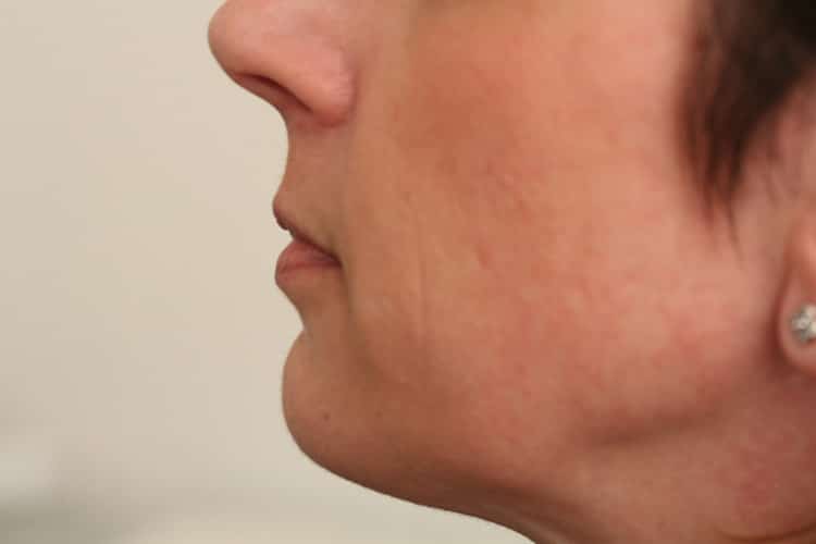 Before Image: Lips Juvederm Ultra - left-side