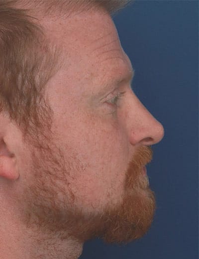 After Image: Rhinoplasty - right-side