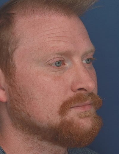 After Image: Rhinoplasty - front