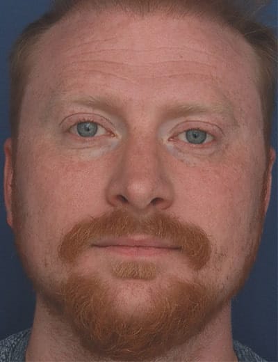After Image: Rhinoplasty -