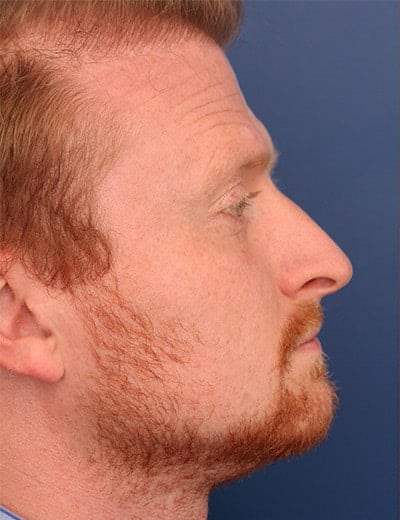 Before Image: Rhinoplasty - right-side
