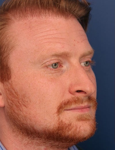 Before Image: Rhinoplasty - front