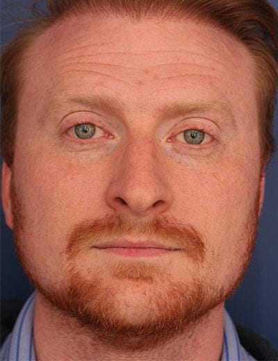 Before Image: Rhinoplasty -