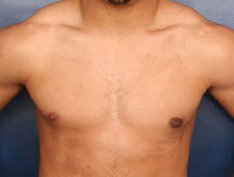 After Image: Gynecomastia - front