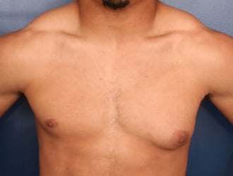 Before Image: Gynecomastia - front