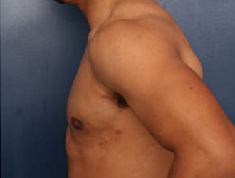 After Image: Gynecomastia - left-side