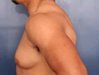 Before Image: Gynecomastia - left-side