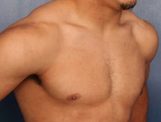 After Image: Gynecomastia - right-front-oblique