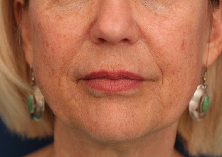 After Image: NL Vollure – Volbella – Juvederm Ultra - front