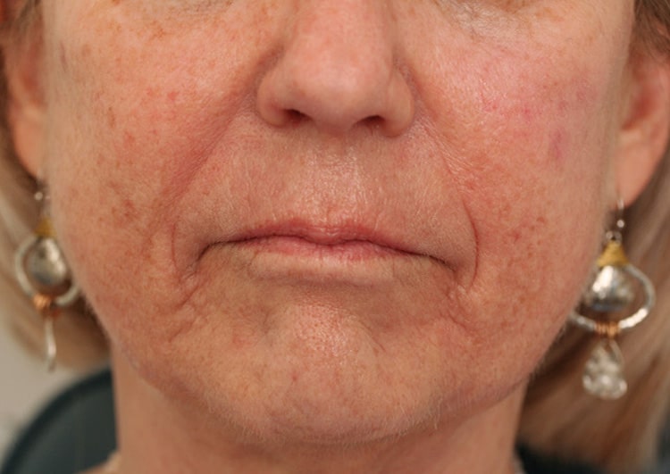 Before Image: NL Vollure – Volbella – Juvederm Ultra - front