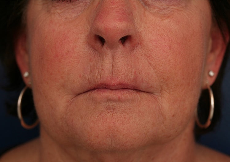 After Image: NL and Lip lines Perlane and Restylane - front